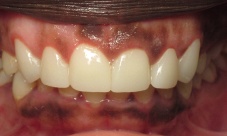 Gingival contouring, upper canine to canine crowns, to correct alignment, discoloration, decay and gum line.