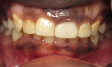 Gingival contouring, upper canine to canine crowns, to correct alignment, discoloration, decay and gum line.