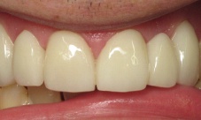 Upper crowns and bridge to correct alignment, replace missing teeth, close spacing and discoloration.