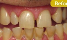 Upper crowns and bridge to correct alignment, replace missing teeth, close spacing and discoloration.