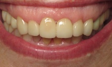 Upper canine to canine crowns with gingival contouring to correct gum line, discoloration, alignment and  fractured teeth.