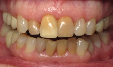 Upper canine to canine crowns with gingival contouring to correct gum line, discoloration, alignment and  fractured teeth.